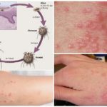 Symptoms of scabies