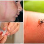 The effects of a tick bite