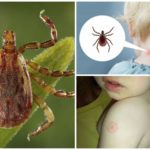 Children's tick bite