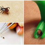 Tick ​​removal