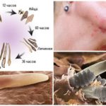 سوس Demodex في مراحل مختلفة من التنمية