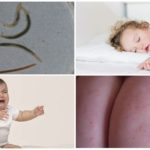 Pinworms in children up to a year