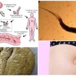 Pinworm инфекция