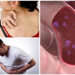 Signs of Giardiasis